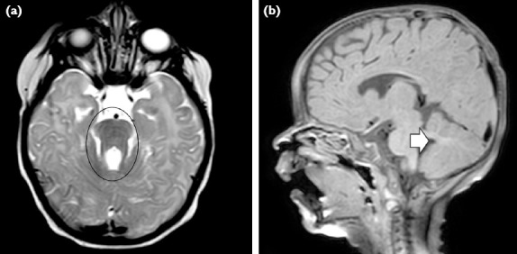 A Report on Children with CEP290 Mutation, Vision Loss, and Developmental Delay.