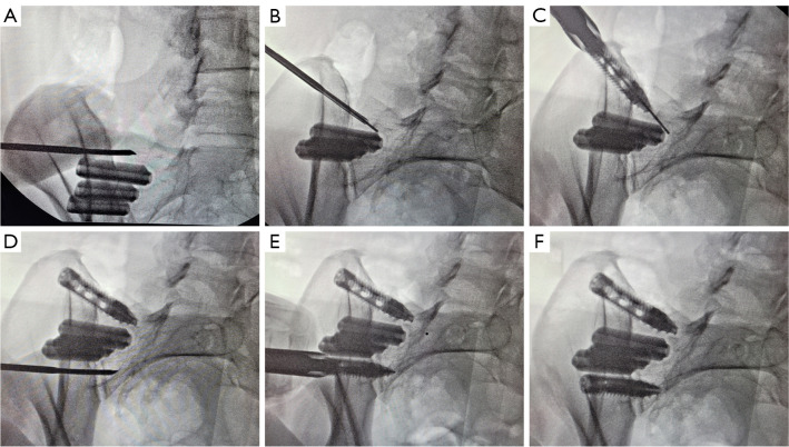 Salvage of failed direct lateral sacroiliac joint fixation using a new percutaneous lateral-oblique transfixation technique with two variable-threaded screws: a multicenter case report of three cases.