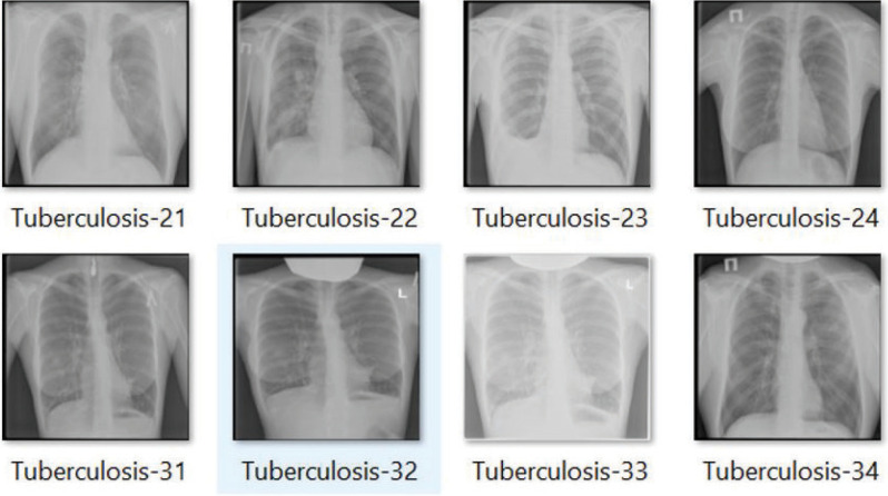 Early detection of tuberculosis using hybrid feature descriptors and deep learning network.