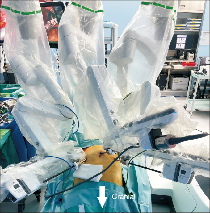 Early outcomes of robotic transabdominal preperitoneal inguinal hernia repair: a retrospective single-institution study in Korea.