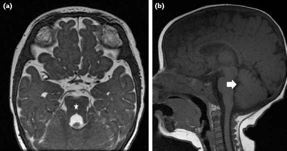 A Report on Children with CEP290 Mutation, Vision Loss, and Developmental Delay.