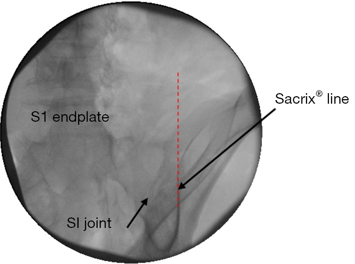 Salvage of failed direct lateral sacroiliac joint fixation using a new percutaneous lateral-oblique transfixation technique with two variable-threaded screws: a multicenter case report of three cases.