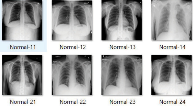 Early detection of tuberculosis using hybrid feature descriptors and deep learning network.