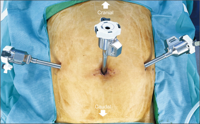 Early outcomes of robotic transabdominal preperitoneal inguinal hernia repair: a retrospective single-institution study in Korea.