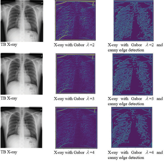 Early detection of tuberculosis using hybrid feature descriptors and deep learning network.