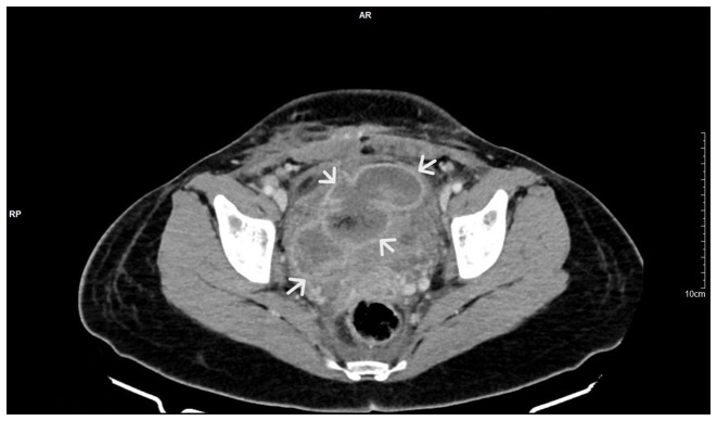 Large bladder flap haematoma following a caesarean section associated with right hydroureteronephrosis: A case report and a mini‑review of the literature.