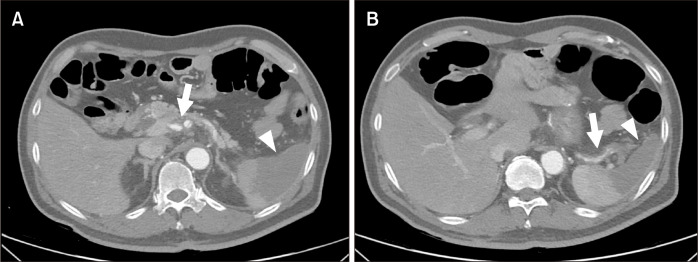 Spontaneous Celiac Artery Dissection with Splenic Infarction: A Report of Two Cases.