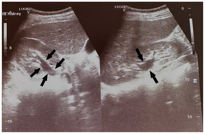 Large bladder flap haematoma following a caesarean section associated with right hydroureteronephrosis: A case report and a mini‑review of the literature.