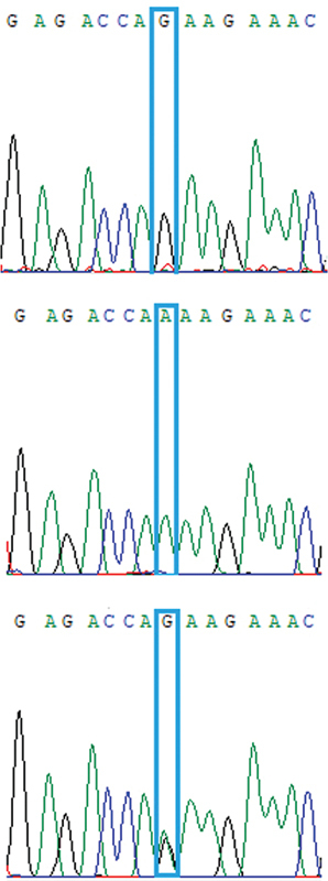 <i>ADAR</i> Expression and Single Nucleotide Variants in Multiple Sclerosis Patients Affect the Response to Interferon Beta Therapy.