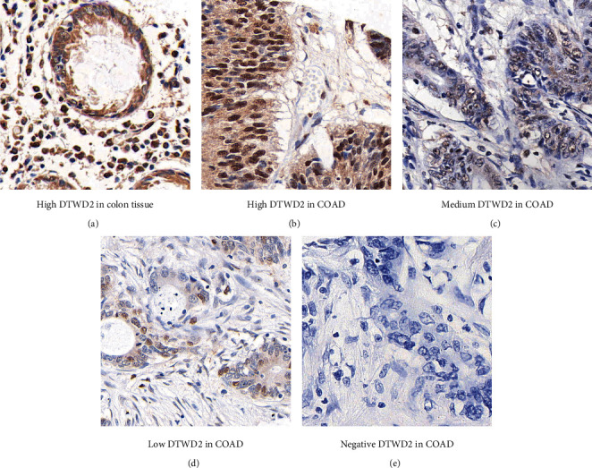 tRNA-Uridine Aminocarboxypropyltransferase DTW Domain Containing 2 Suppresses Colon Adenocarcinoma Progression.