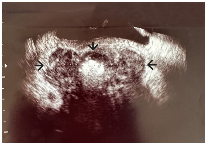 Large bladder flap haematoma following a caesarean section associated with right hydroureteronephrosis: A case report and a mini‑review of the literature.