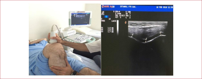 The relationship between quadriceps femoris thickness measured by US and femoral cartilage thickness in knee osteoarthritis, its effect on radiographic stage and clinical parameters: comparison with healthy young population.