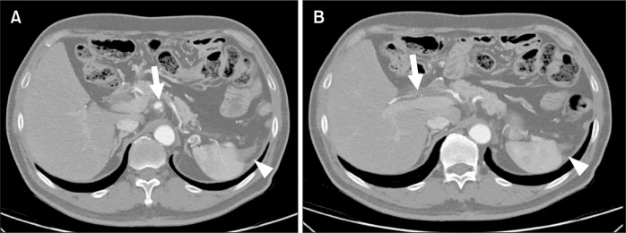 Spontaneous Celiac Artery Dissection with Splenic Infarction: A Report of Two Cases.