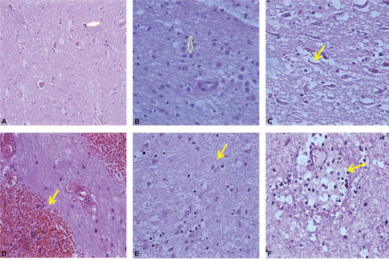 Pathological Spectrum and β-APP Immunoreactivity as a Diagnostic Tool of Diffuse Axonal Injury following Traumatic Brain Injury: A Novel Classification.