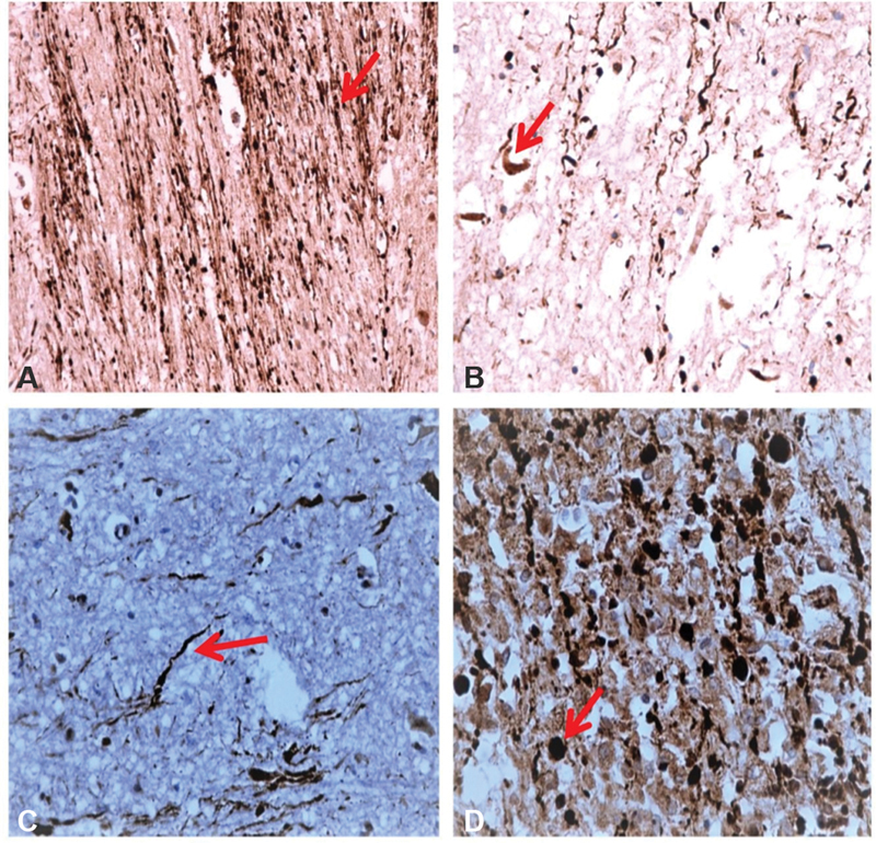 Pathological Spectrum and β-APP Immunoreactivity as a Diagnostic Tool of Diffuse Axonal Injury following Traumatic Brain Injury: A Novel Classification.