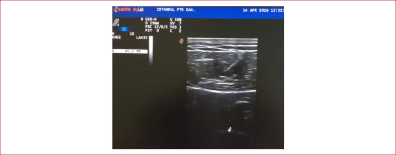 The relationship between quadriceps femoris thickness measured by US and femoral cartilage thickness in knee osteoarthritis, its effect on radiographic stage and clinical parameters: comparison with healthy young population.