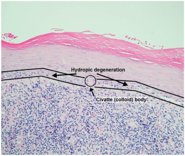 Assessing the Agreement of Light Microscopic Evaluation of Oral Lichen Planus Lesions With Associated Direct Immunofluorescence Evaluation.