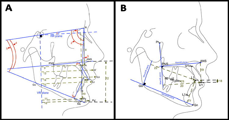 Conventional Twin-Block Versus Cervical Headgear and Twin-Block Combination: Therapeutic Effects on the Craniofacial Structures in Growing Subjects.