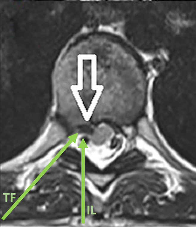 Full-endoscopic thoracic spine approaches.