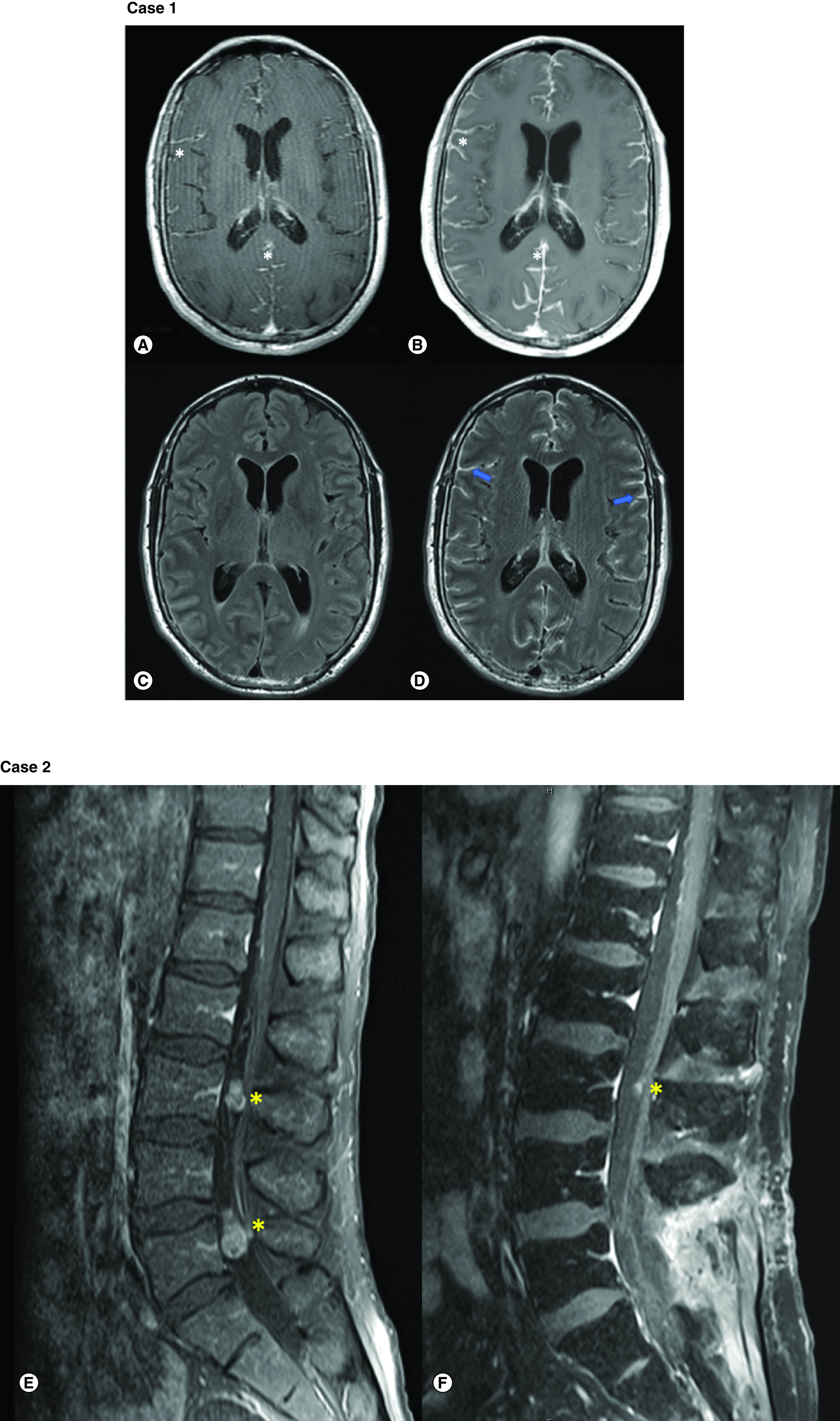 HER2+ esophageal carcinoma leptomeningeal metastases treated with intrathecal trastuzumab regimen.