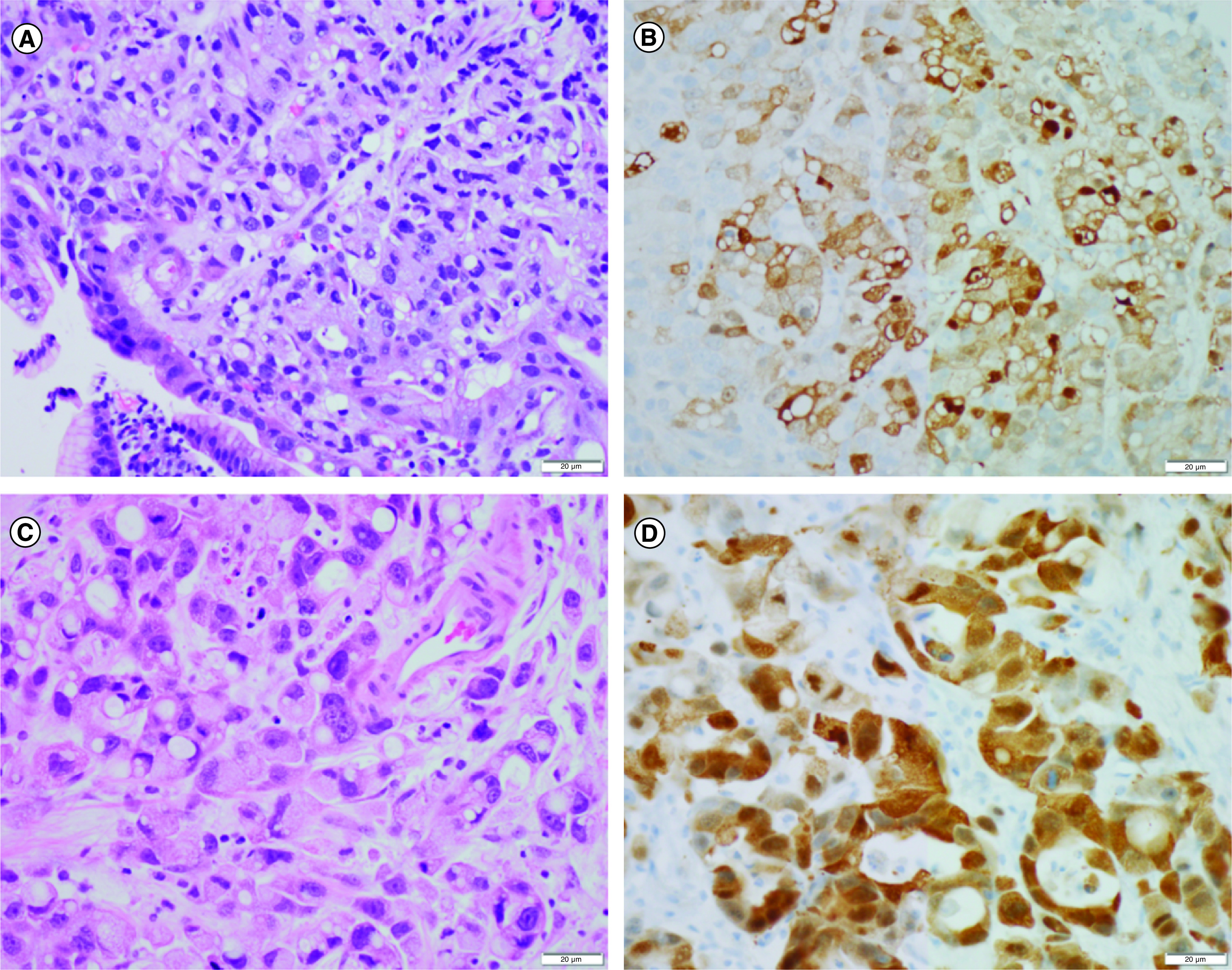 HER2+ esophageal carcinoma leptomeningeal metastases treated with intrathecal trastuzumab regimen.