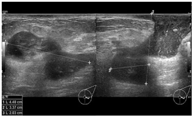 Cystic neutrophilic granulomatous mastitis: A case report and review of the literature.