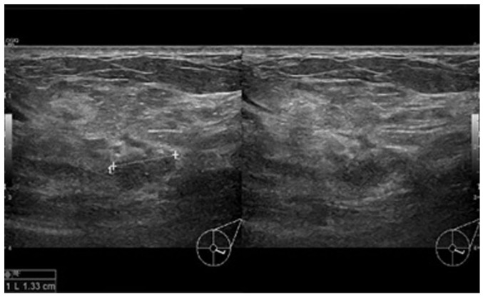 Cystic neutrophilic granulomatous mastitis: A case report and review of the literature.