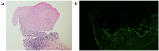 Assessing the Agreement of Light Microscopic Evaluation of Oral Lichen Planus Lesions With Associated Direct Immunofluorescence Evaluation.