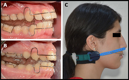 Conventional Twin-Block Versus Cervical Headgear and Twin-Block Combination: Therapeutic Effects on the Craniofacial Structures in Growing Subjects.