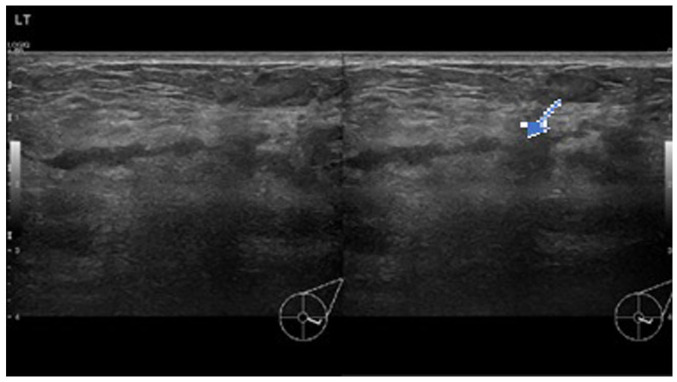 Cystic neutrophilic granulomatous mastitis: A case report and review of the literature.