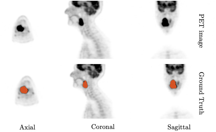 From coarse to fine: a deep 3D probability volume contours framework for tumour segmentation and dose painting in PET images.