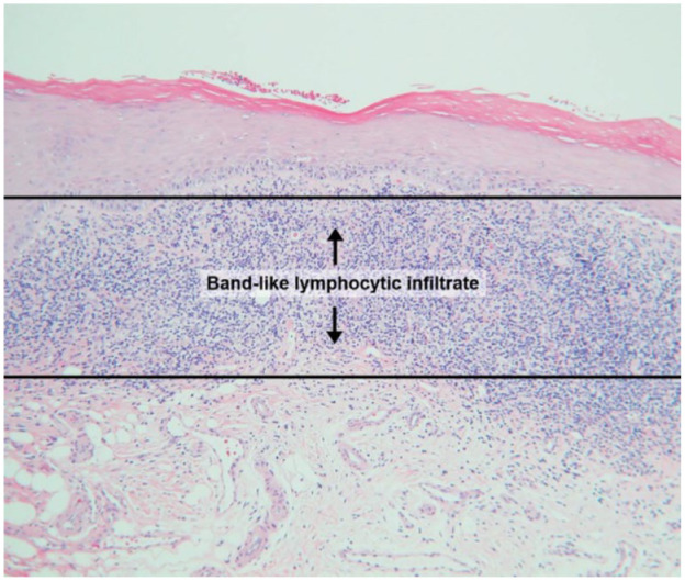 Assessing the Agreement of Light Microscopic Evaluation of Oral Lichen Planus Lesions With Associated Direct Immunofluorescence Evaluation.