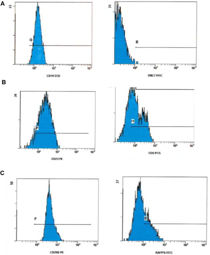 The Use of CD200 in the Differential Diagnosis of B-Cell Lymphoproliferative Disorders.