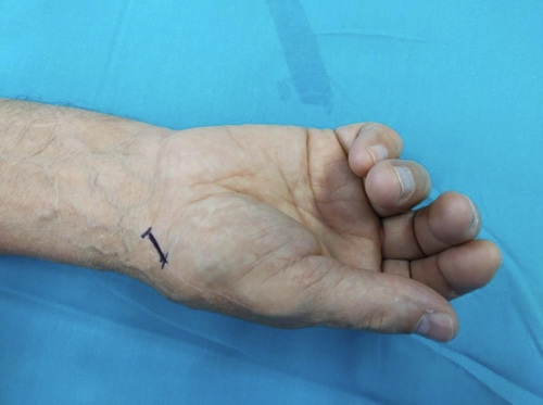 Transosseous Cannula Suture Suspensionplasty for Thumb Basal Joint Arthritis: A Novel Technique.