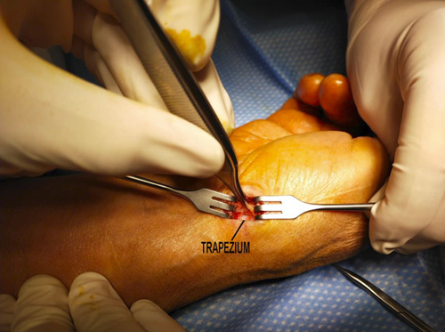 Transosseous Cannula Suture Suspensionplasty for Thumb Basal Joint Arthritis: A Novel Technique.