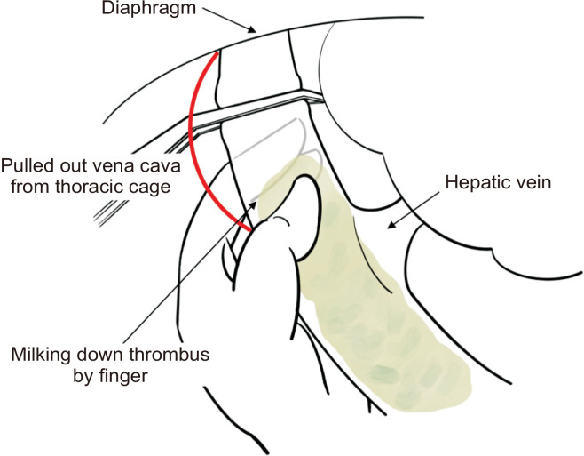 Technical Tips for Performing Suprahepatic Vena Cava Tumor Thrombectomy in Renal Cell Carcinoma without Using Cardiopulmonary Bypass.