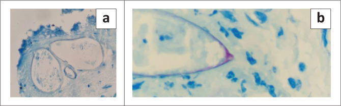 A case of pericardial schistosomiasis and non-Hodgkin high grade B-cell lymphoma.