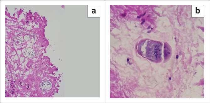 A case of pericardial schistosomiasis and non-Hodgkin high grade B-cell lymphoma.