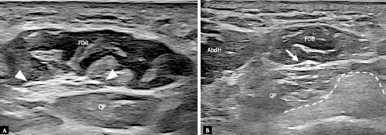 Ultrasound of the plantar foot: a guide for the assessment of plantar intrinsic muscles.