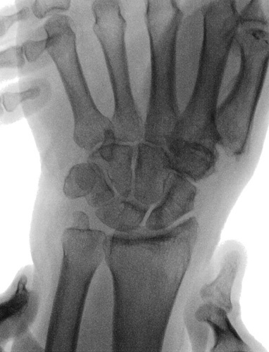 Transosseous Cannula Suture Suspensionplasty for Thumb Basal Joint Arthritis: A Novel Technique.