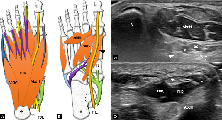 Ultrasound of the plantar foot: a guide for the assessment of plantar intrinsic muscles.