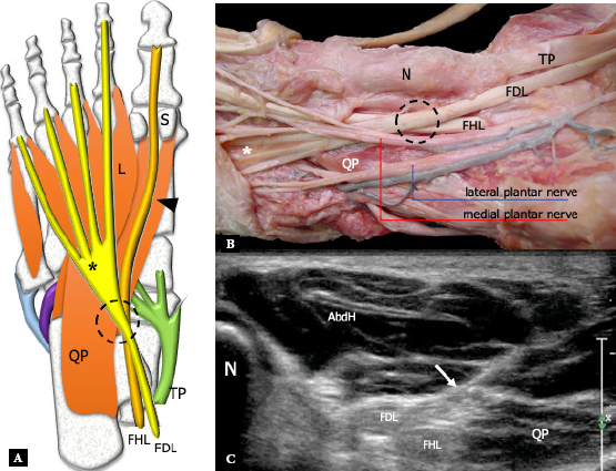 Ultrasound of the plantar foot: a guide for the assessment of plantar intrinsic muscles.