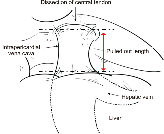 Technical Tips for Performing Suprahepatic Vena Cava Tumor Thrombectomy in Renal Cell Carcinoma without Using Cardiopulmonary Bypass.