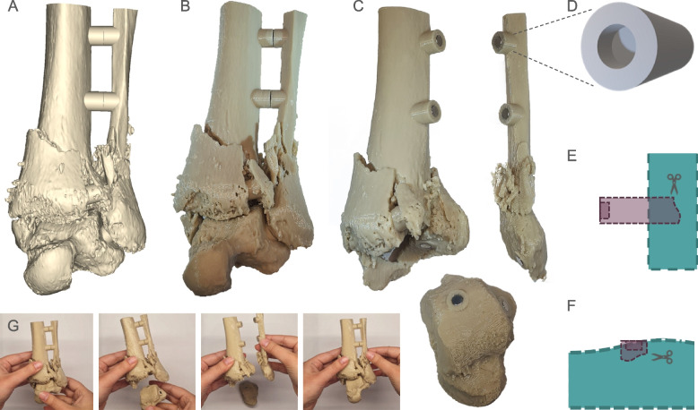 Technical improvements in preparing 3D printed anatomical models for comminuted fracture preoperative planning.