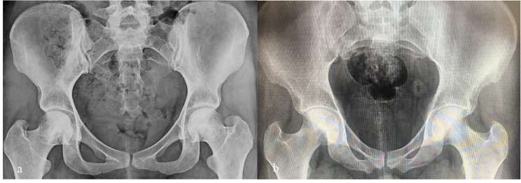 Core decompression combined with local DFO administration loaded on polylactic glycolic acid scaffolds for the treatment of osteonecrosis of the femoral head: a pilot study.