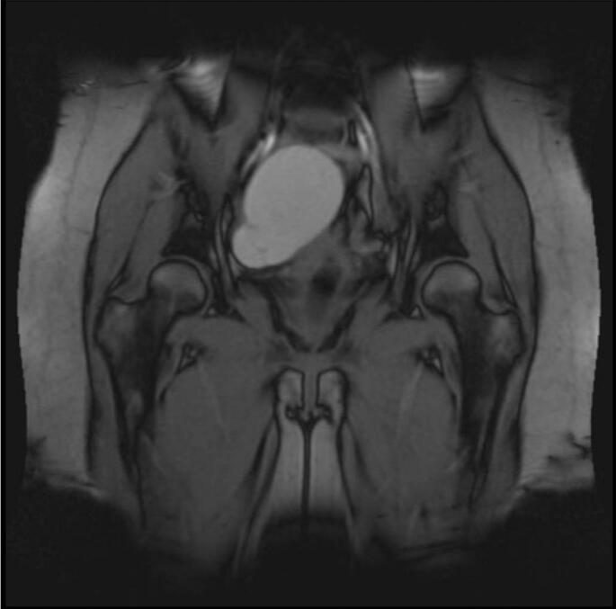 Tubo-ovarian abscess after vaginal delivery: A case report and review of current literature