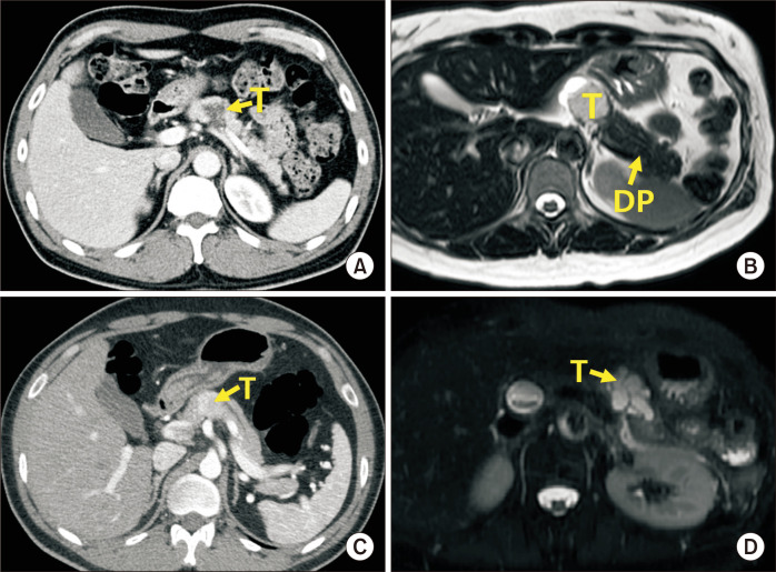 Robotic central pancreatectomy: a surgical technique.