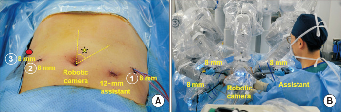 Robotic central pancreatectomy: a surgical technique.