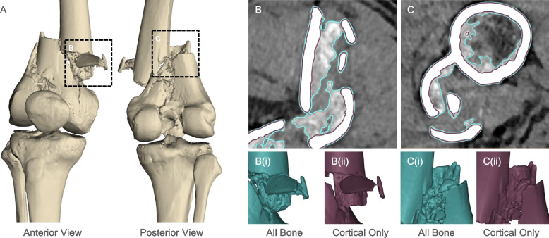 Technical improvements in preparing 3D printed anatomical models for comminuted fracture preoperative planning.