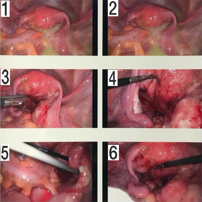 Tubo-ovarian abscess after vaginal delivery: A case report and review of current literature